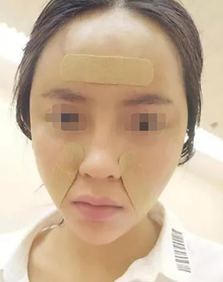 北京自体脂肪填充额头、苹果肌,案例分享