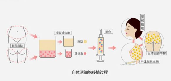 北京自体脂肪填充额头、苹果肌,案例分享