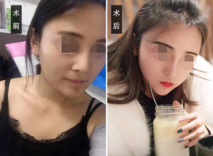 想做素颜女神?!如何用微整拼颜值!
