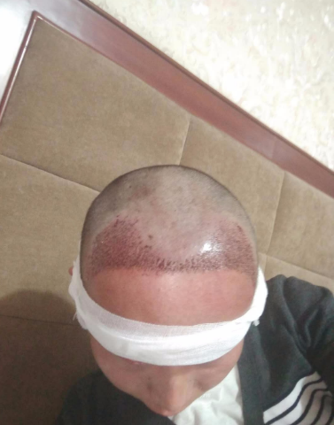上海王先生头发种植案例分享