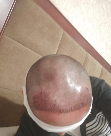 上海王先生头发种植案例分享