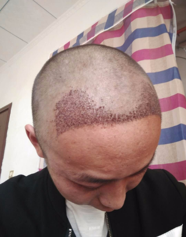 上海王先生头发种植案例分享