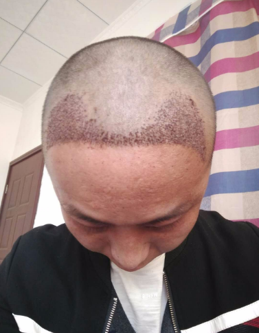 上海王先生头发种植案例分享