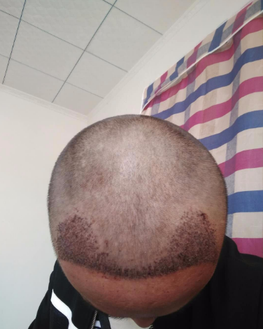 上海王先生头发种植案例分享