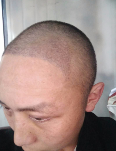 上海王先生头发种植案例分享