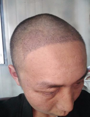 上海王先生头发种植案例分享