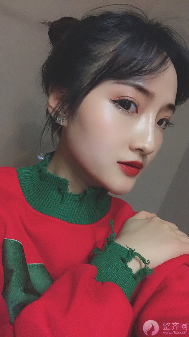 同样是埋线,为什么你的维持时间那么短?