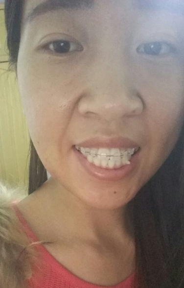 牙齿矫正前后对比案例,牙好笑的才好看!