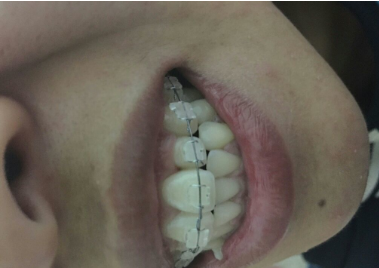 牙齿矫正前后对比案例,牙好笑的才好看!