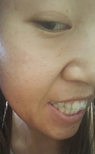 牙齿矫正前后对比案例,牙好笑的才好看!