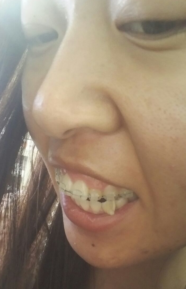 牙齿矫正前后对比案例,牙好笑的才好看!
