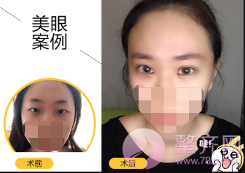 在这个较适合割双眼皮的季节,看看她们是如何