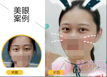 在这个较适合割双眼皮的季节,看看她们是如何