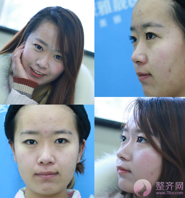 双眼皮+隆鼻的案例,改变不止一点点