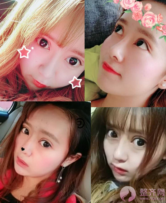 双眼皮+隆鼻的案例,改变不止一点点