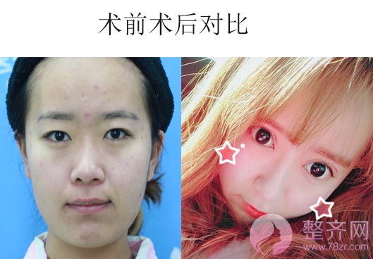 双眼皮+隆鼻的案例,改变不止一点点