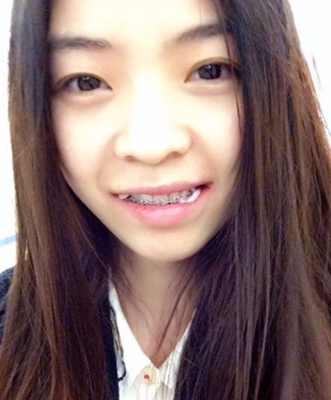 牙齿矫正术前术后对比案例,和牙套君恋爱的日子,不再做龅牙妹!