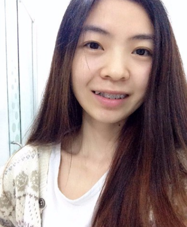 牙齿矫正术前术后对比案例,和牙套君恋爱的日子,不再做龅牙妹!