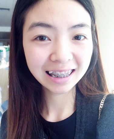 牙齿矫正术前术后对比案例,和牙套君恋爱的日子,不再做龅牙妹!