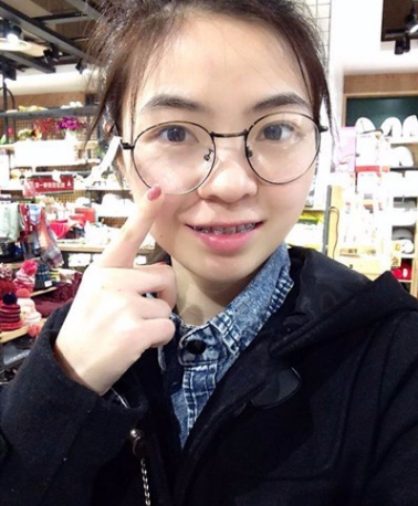 牙齿矫正术前术后对比案例,和牙套君恋爱的日子,不再做龅牙妹!