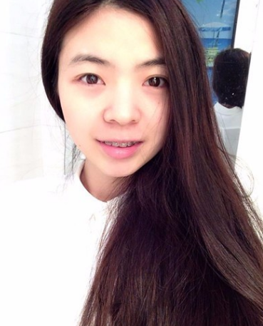 牙齿矫正术前术后对比案例,和牙套君恋爱的日子,不再做龅牙妹!