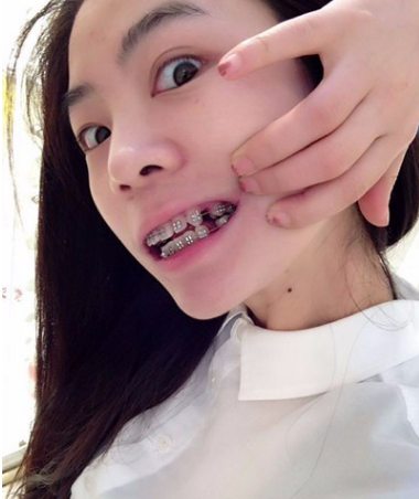 牙齿矫正术前术后对比案例,和牙套君恋爱的日子,不再做龅牙妹!