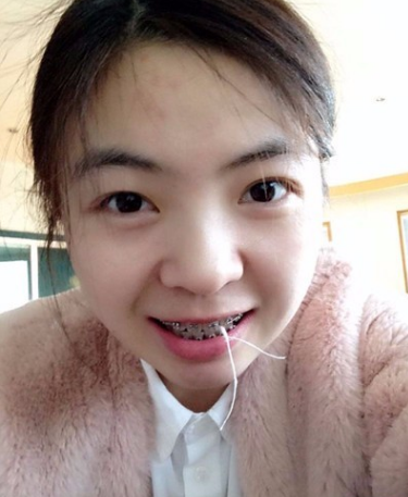牙齿矫正术前术后对比案例,和牙套君恋爱的日子,不再做龅牙妹!
