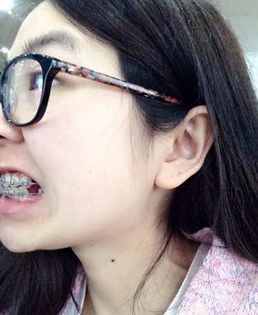牙齿矫正术前术后对比案例,和牙套君恋爱的日子,不再做龅牙妹!