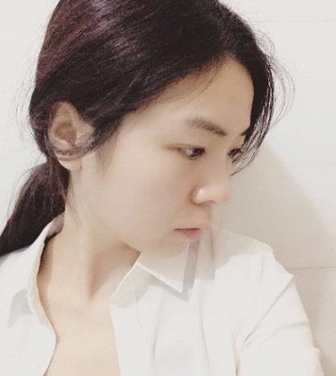 牙齿矫正术前术后对比案例,和牙套君恋爱的日子,不再做龅牙妹!