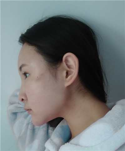 小模特的面部吸脂经历分享,小仙女让自己变的更美!