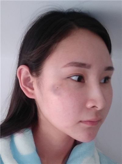 小模特的面部吸脂经历分享,小仙女让自己变的更美!