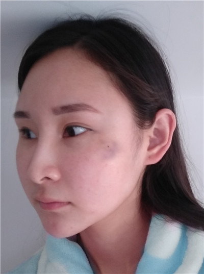 小模特的面部吸脂经历分享,小仙女让自己变的更美!