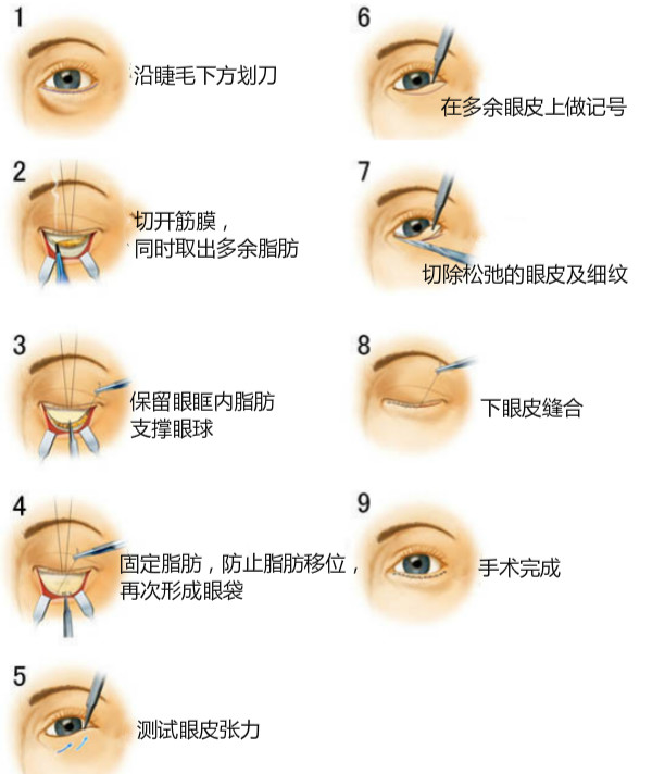 解决眼袋、黑眼圈,老阿姨秒变小姐姐