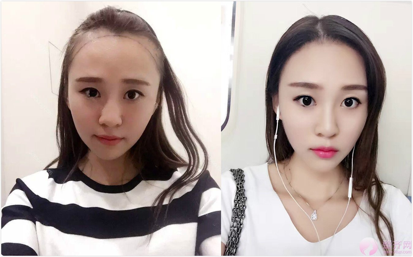 漂亮的额头到底长什么样?发际线来告诉你