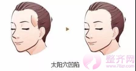 面部凹陷的女人为什么会显老10岁?