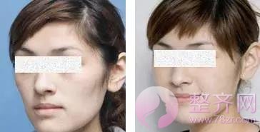 面部凹陷的女人为什么会显老10岁?