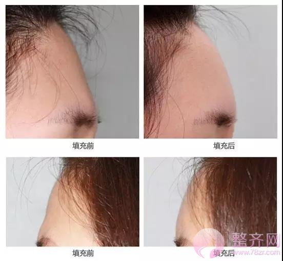 面部凹陷的女人为什么会显老10岁?