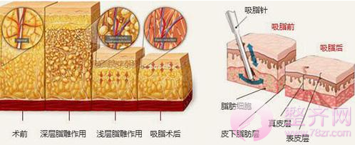 抽脂减肥手术对身体有危害吗?