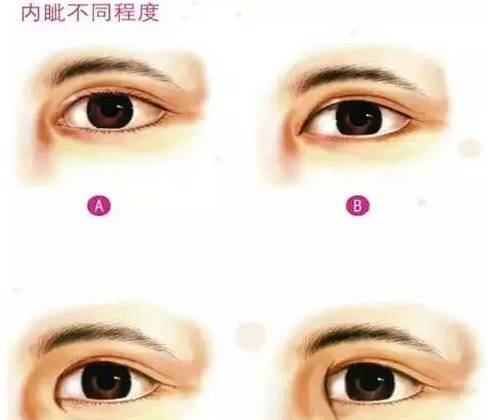 需不需要开眼角?还在犹豫的你进来看看吧!