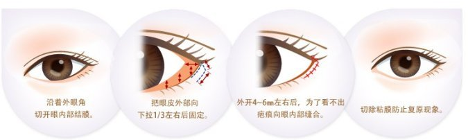 需不需要开眼角?还在犹豫的你进来看看吧!
