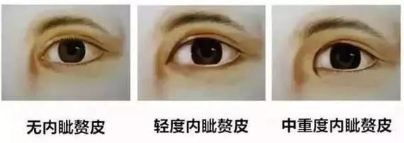 需不需要开眼角?还在犹豫的你进来看看吧!