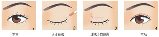 想做双眼皮,埋线or切开该如何抉择?