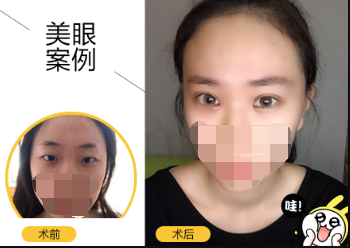 想做双眼皮,埋线or切开该如何抉择?