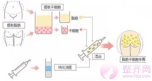 自体脂肪移植填充,又瘦又美!