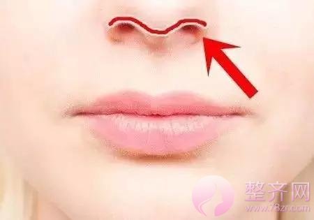 膨体隆鼻+耳软骨,鼻尖保护和塑性两不误!