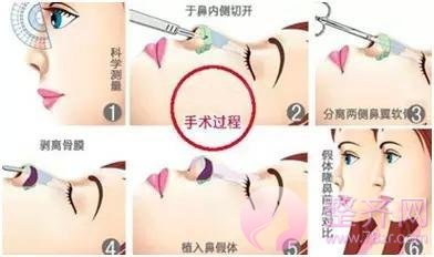 膨体隆鼻+耳软骨,鼻尖保护和塑性两不误!