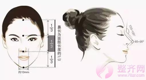 膨体隆鼻+耳软骨,鼻尖保护和塑性两不误!