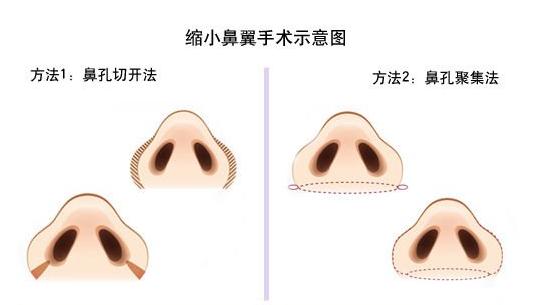 鼻翼整形,让你鼻子更小巧!