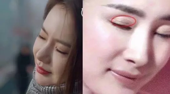 戚薇霸气公开割双眼皮,你还在犹豫吗?