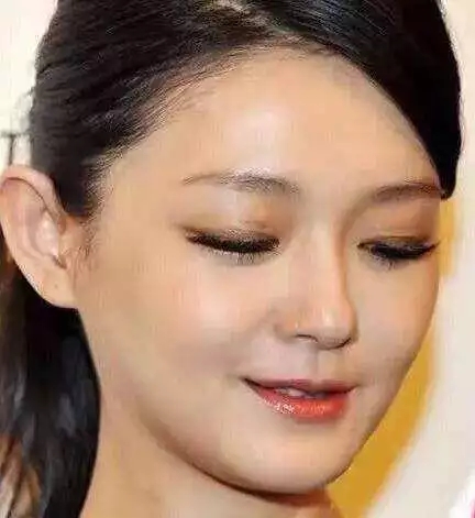 戚薇霸气公开割双眼皮,你还在犹豫吗?